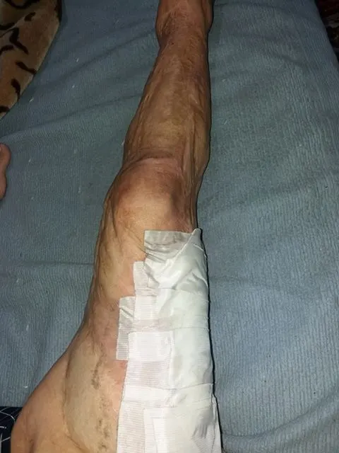 Stafilococul auriu contactat în spital îi pune viața în pericol unei tinere din Vrancea