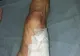 Stafilococul auriu contactat în spital îi pune viața în pericol unei tinere din Vrancea